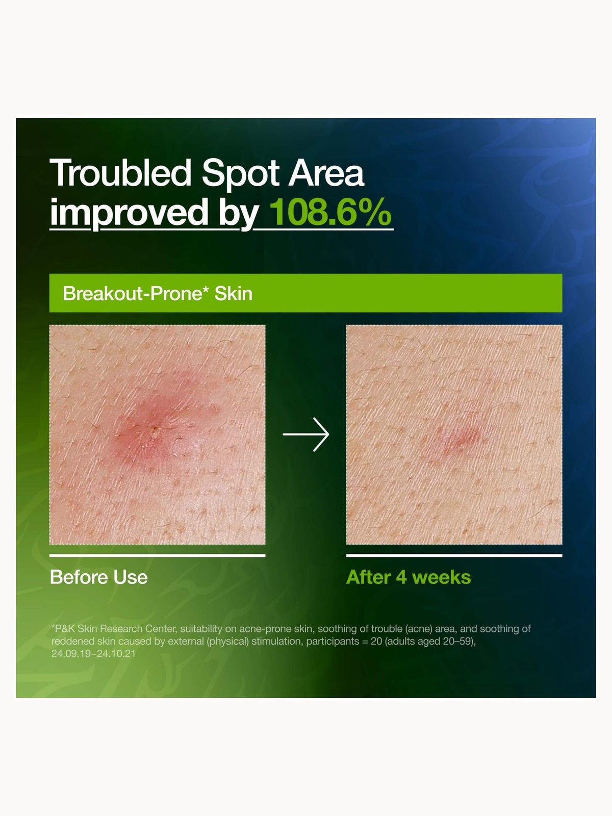 Anua Azelaic Acid 10 + Hyaluron Redness Soothing Serum 50Ml - K-Pop Demon Hunters Edition